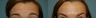 Botox: Before and After