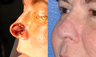 Nasal Ala Reconstruction After Mohs Surgery