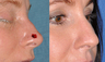 Nasal Tip Reconstruction After Mohs Surgery