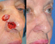 Nasal Sidewall & Ala Reconstruction After Mohs Surgery