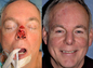 Nasal Dorsum & Tip Reconstruction with Paramedian Forehead Flap