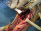 Nerve transfer