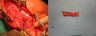 Ulnar artery reconstruction