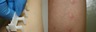 Skin testing