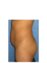 Brazilian Buttock Lift Before