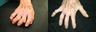 Severe Finger Arthritis