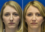 Rhinoplasty Before and After photo