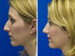 Nasal Bump Rhinoplasty Before and After photo