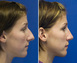 Nasal Bump Rhinoplasty Before and After photo