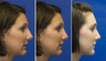 Nasal Bump and Deviated Nose Rhinoplasty Before and After photo