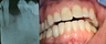 Missing tooth replaced with dental implant