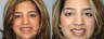 Now Smile Porcelain Veneers