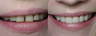 Eight Porcelain veneers