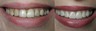 Replacing Old Porcelain Veneers