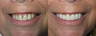 Crowns, Veneer and laser gum recontouring