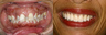 New smile before and after