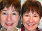 Before and After