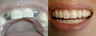 Implants repalcing missing front teeth
