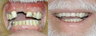 Replacement of missing upper anterior teeth