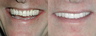 Porcelain crowns, a beautiful smile