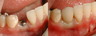 Missing lower cuspid replaced with and implant supported crown